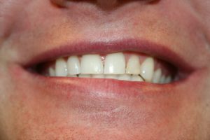 A patient's smile prior to composite veneers.