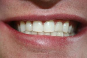 A patient's teeth after being treated with composite veneers.