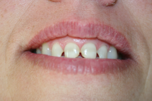 A woman's smile before being treated with composite veneers.