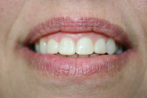 A patient after being treated with composite veneers.