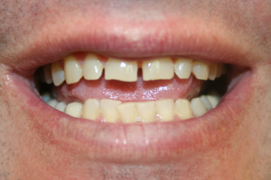 A man's smile prior to composite veneer treamtents.