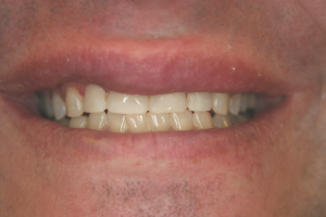 A man' s smile after adding composite veneers.