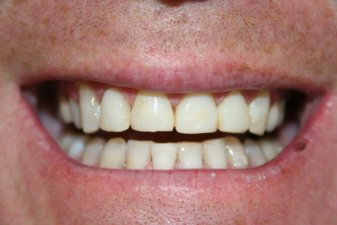 A patient's smile prior to dental crowns.