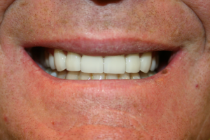An improved smile showing better alignment after dental crowns.