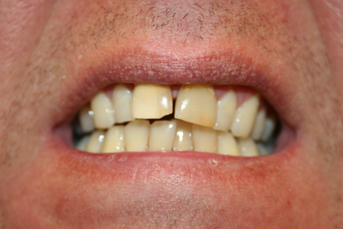 A smile with alignment problems and gaps before dental crowns.