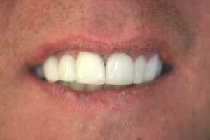 A repaired and improved smile after receiving dental crowns.