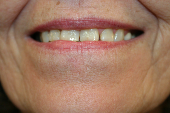 A woman smile in need of dental crowns. to improve damage and gaps.