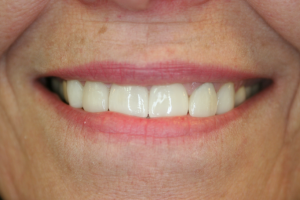 A smile improved with dental crowns from our dentist.