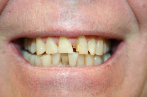 A patient's gapped teeth before adding dental crowns.