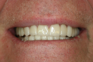 A patient's reshaped and re-spaced smile after dental crowns.