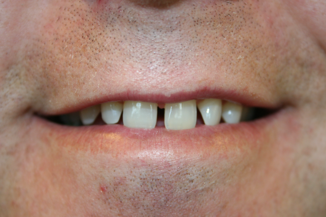 A patient's smile with gaps before dental crowns.