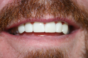 A patient with the gaps closed in their smile after dental crowns.