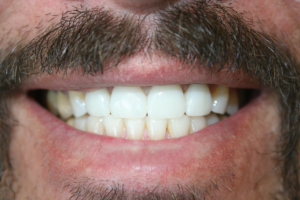 A newly- repaired smile after dental crowns. 