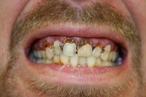 A man's very damaged smile before treatment with dental crowns.