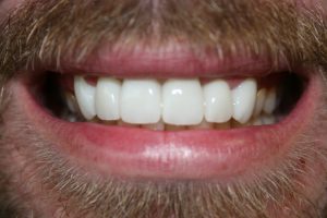 A greatly improved smile following dental crown treatments.