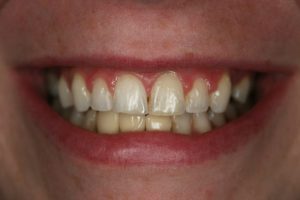 A woman's smile before porcelain veneers. 