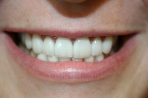 A woman's smile after porcelain veneers.