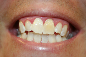 A patient's smile before treatment with veneers.
