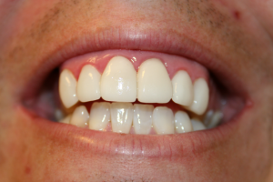 A patient's smile after adding porcelain veneers.