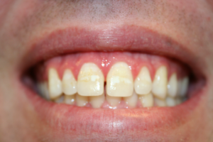 A patient's mouth prior to adding porcelain veneers.
