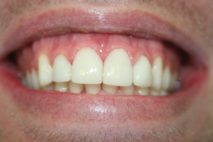 A patient's smile with porcelain veneers.