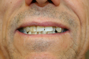 A patient's teeth before dental crowns..