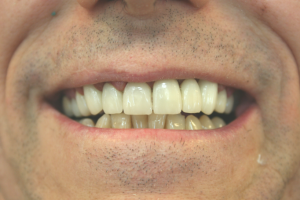 A patient's teeth after receiving dental crowns.