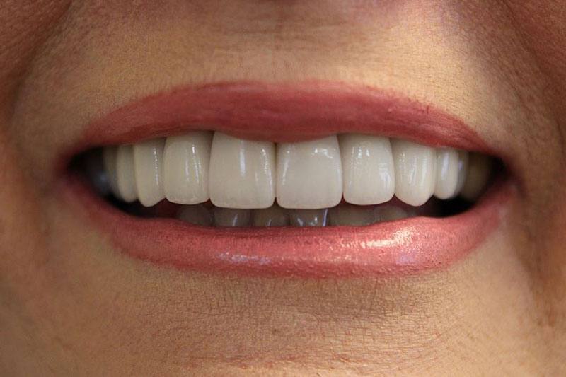 An improved smile after adding dental crowns.