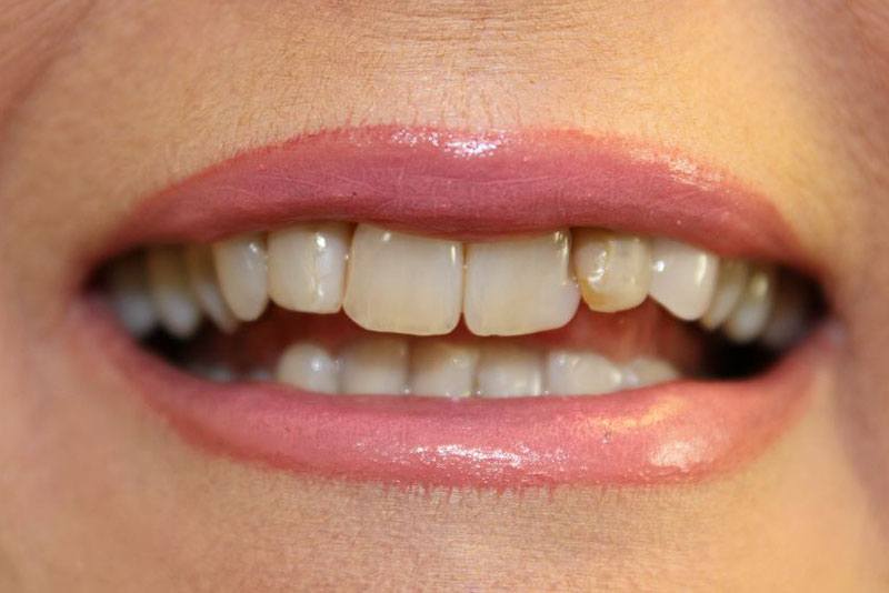 A woman's smile before a dental crown treatment.