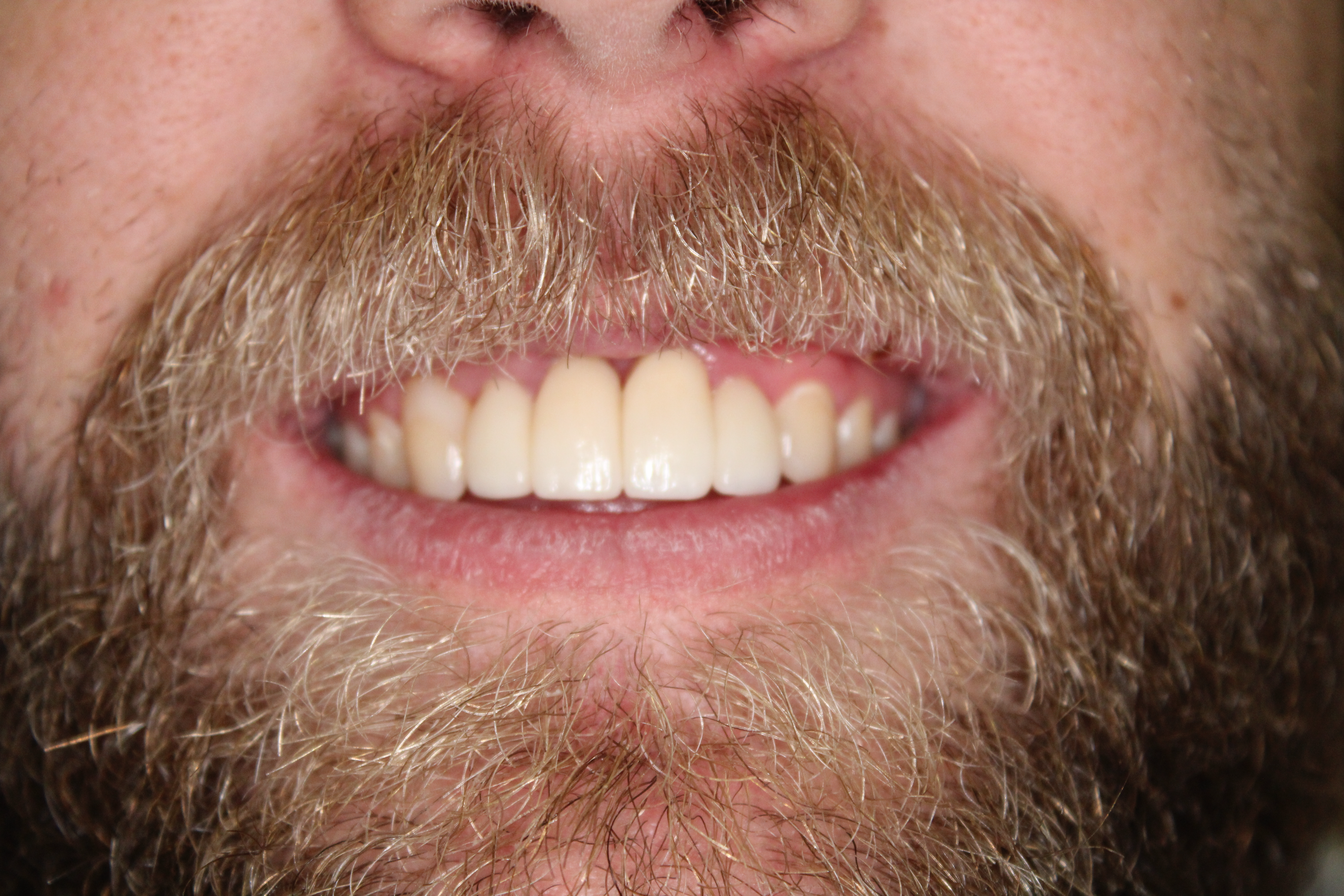 A much-improved smile following a treatment with dental crowns.