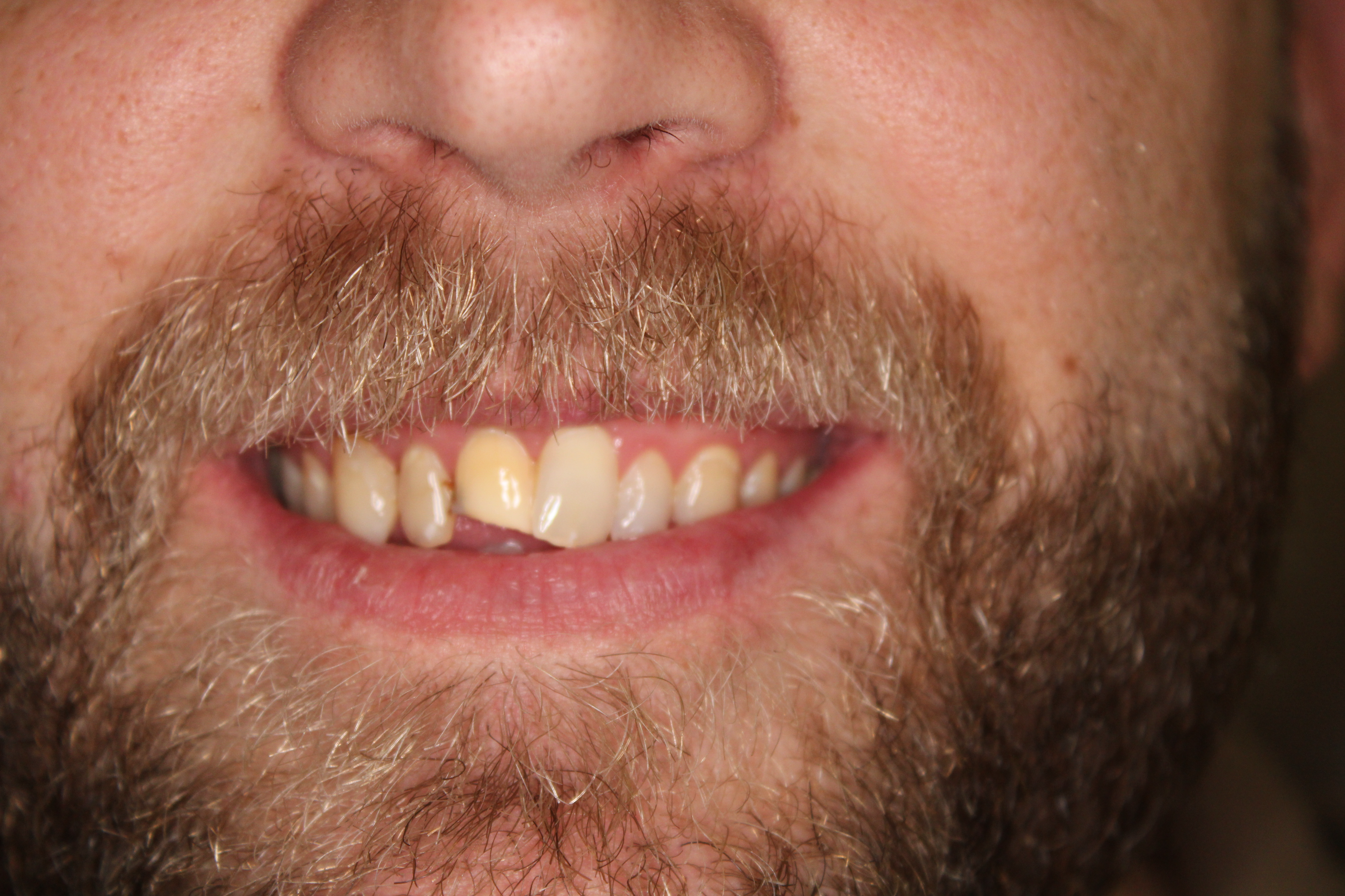 A smile before being treated by our dentist with dental crowns.