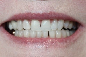 Before Porcelain Veneers