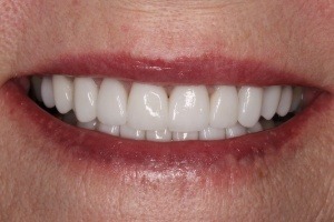 After Porcelain Veneers