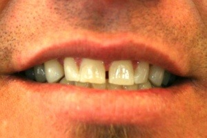 Before Porcelain Veneers