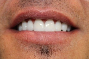 After Porcelain Veneers