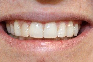 Before Porcelain Veneers