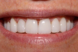 After Porcelain Veneers